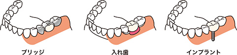 人工的な歯で補う治療には３種類あります